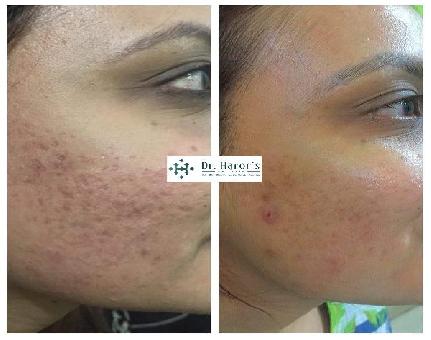 Top Dermatologist in Greater Kailash – Dr. Navnit 