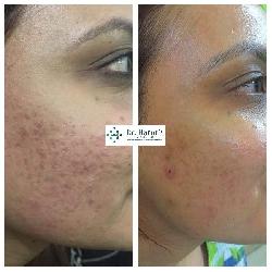Skin Treatment in...