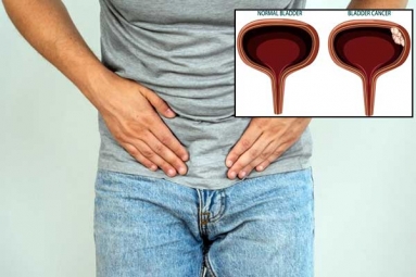 Why is Bladder Cancer Common in Men?