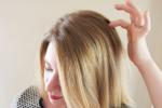 hair loss., Itchy scalp, remedies to get rid of itchy scalp, Itchy scalp hair loss., Itchy scalp, remedies to get rid of itchy scalp, Itchy scalp