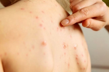 Measles Outbreak in New York Suburb, Unvaccinated Children Barred from Public Spaces
