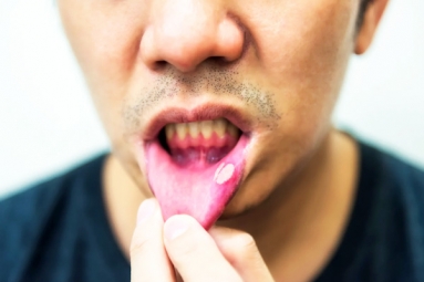 Mouth Ulcers and Home Remedies Mouth Ulcers and Home Remedies