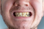 Nicotine stains good for health, Nicotine stains, are nicotine stains on your teeth irreversible, Oral cancer